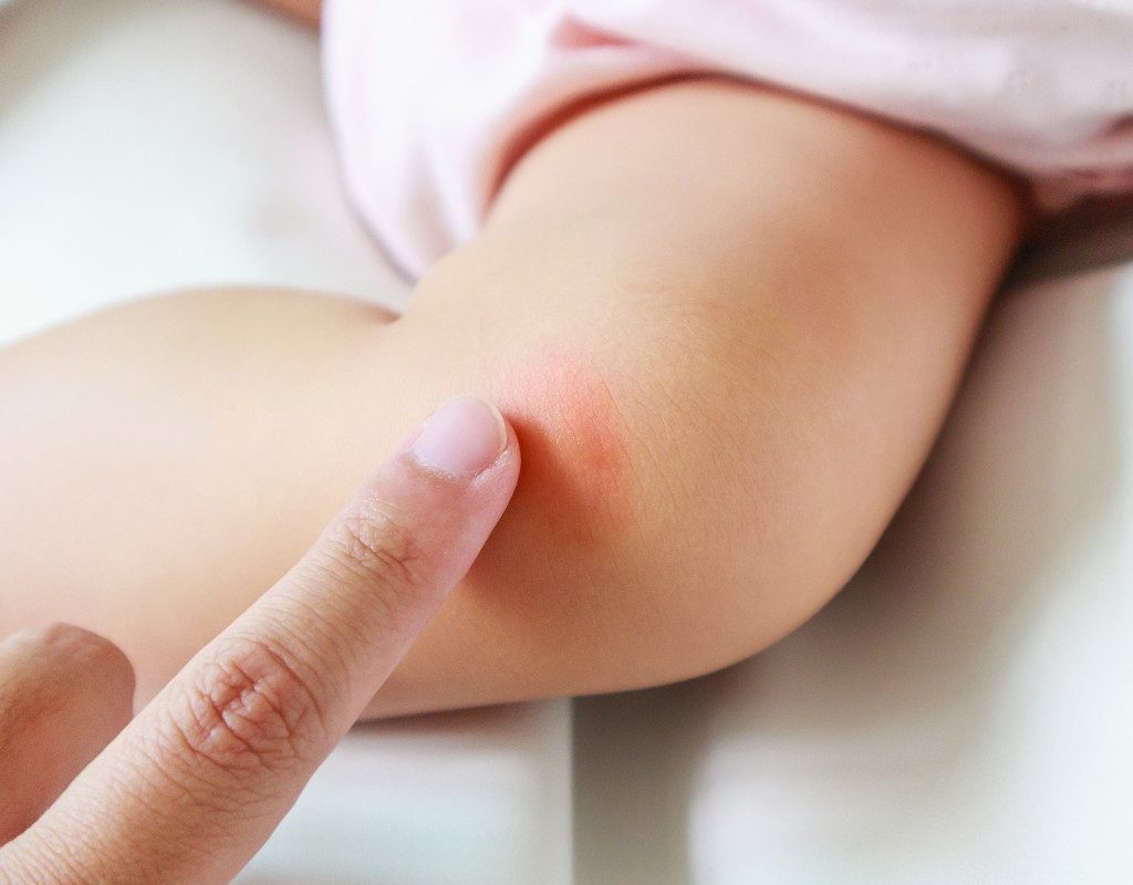 baby with insect bite