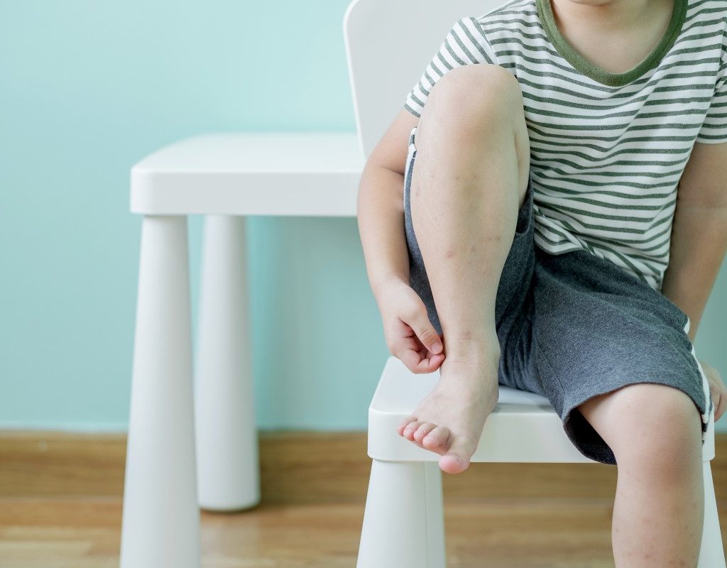 kid with bug bites