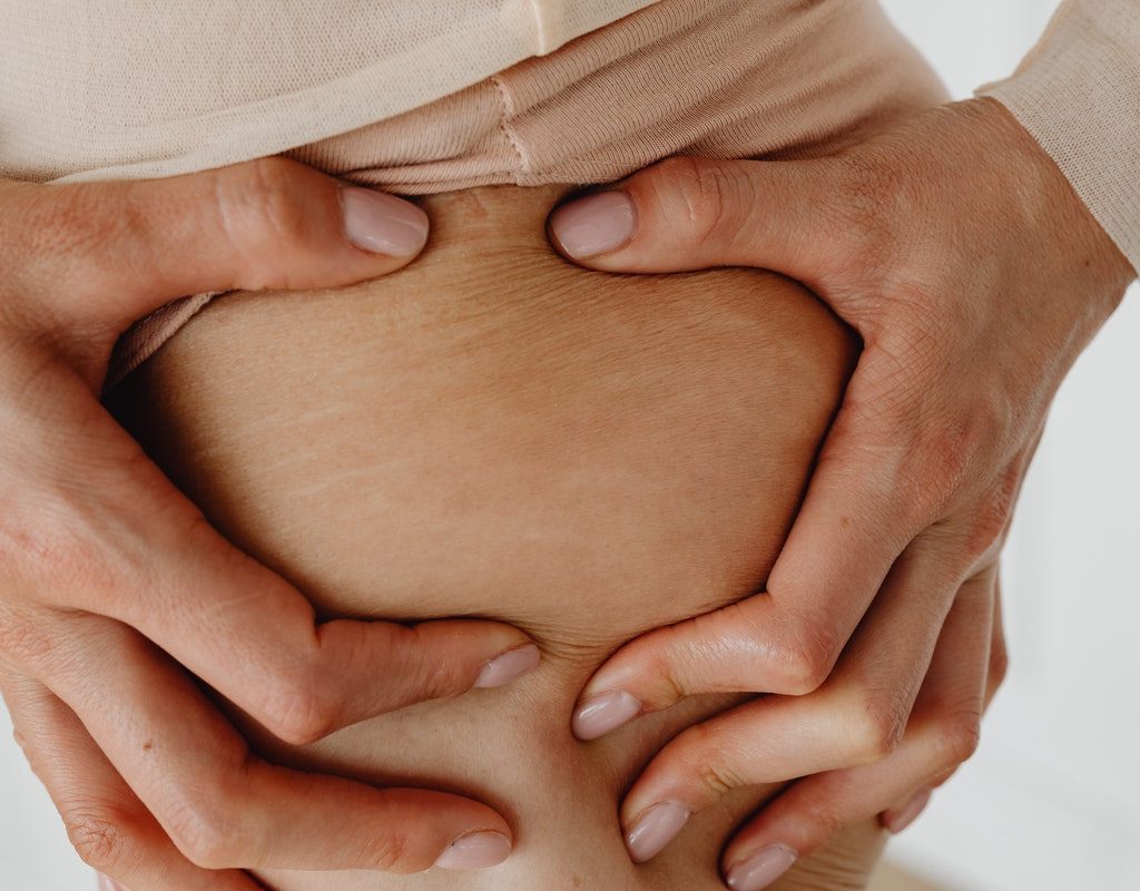 Lady pointing out stretch marks