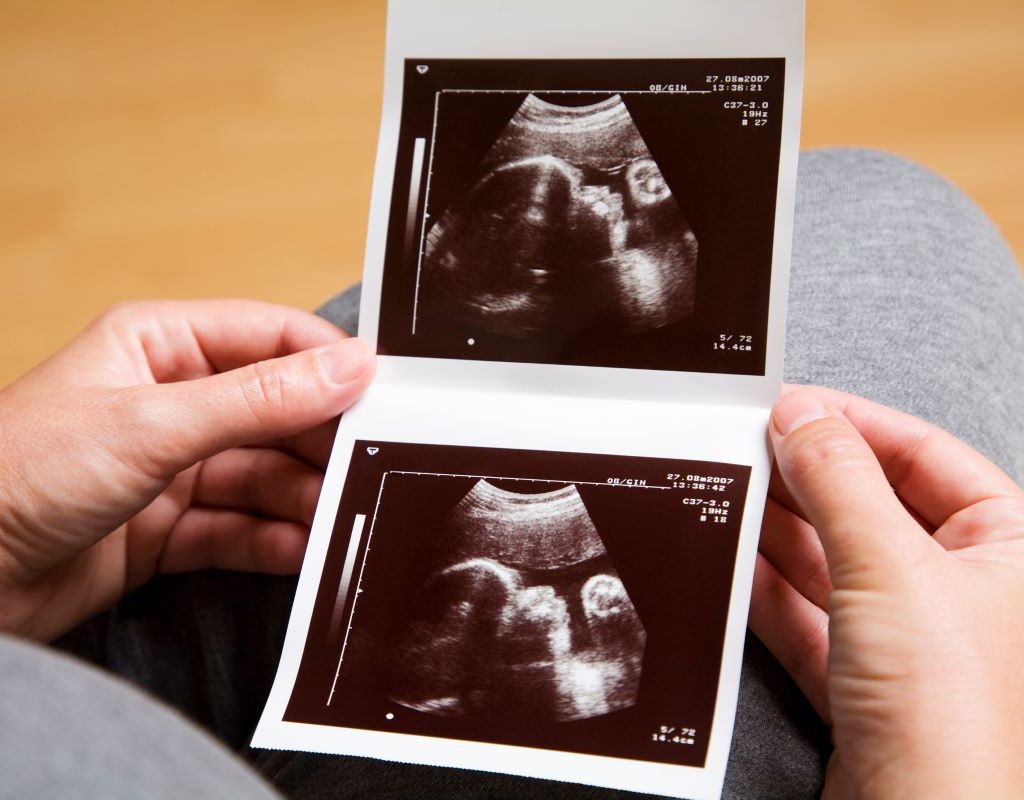 A lady's hands holding two sonogram pictures