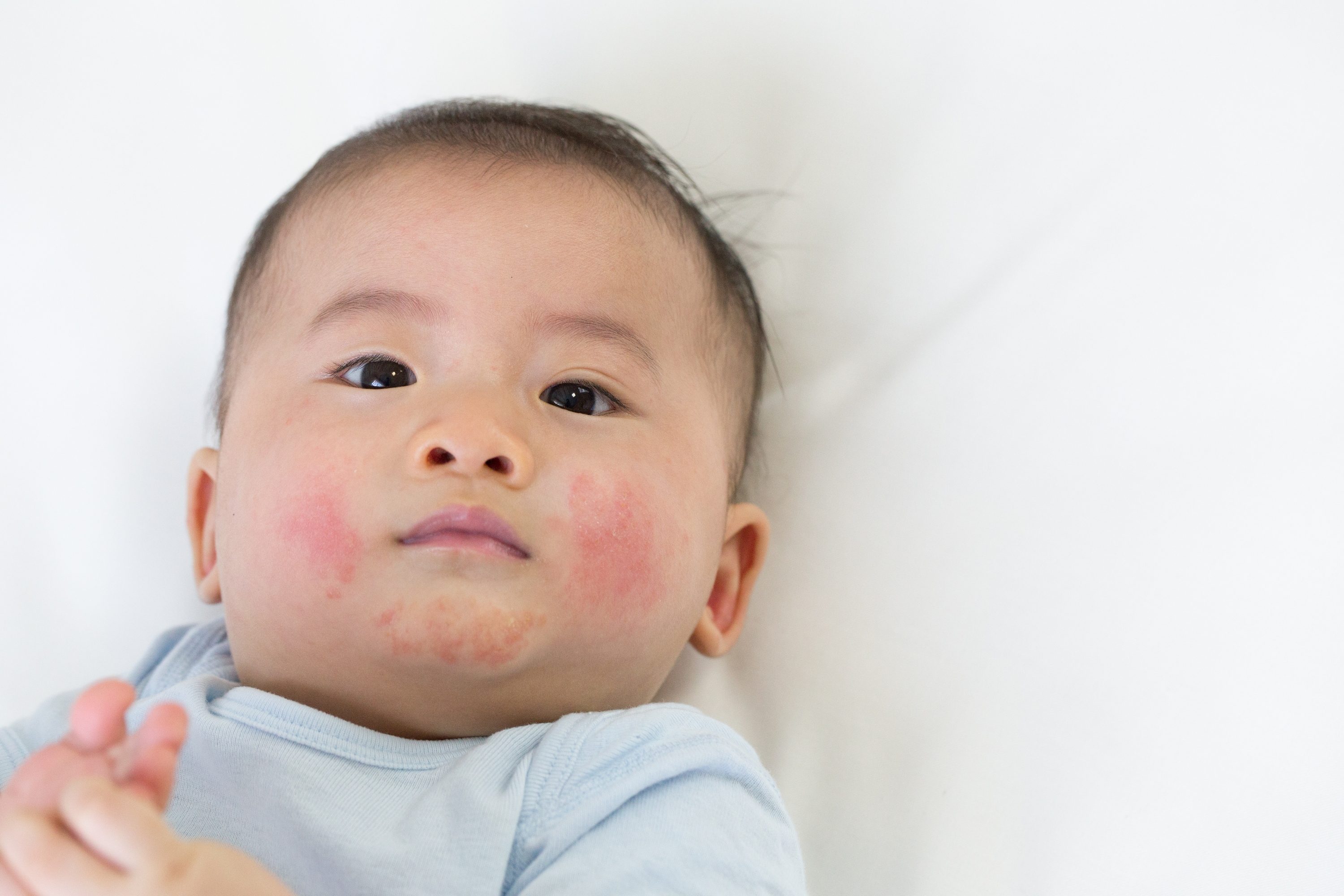 Baby with a possible milk allergy