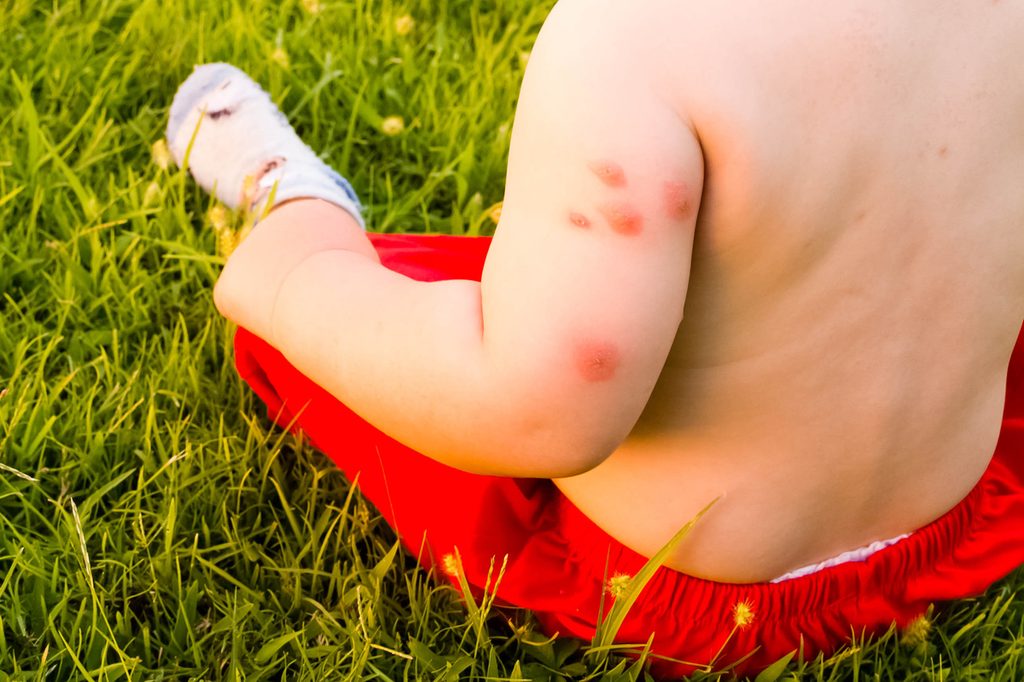 multiple mosquito bites on a baby's arm