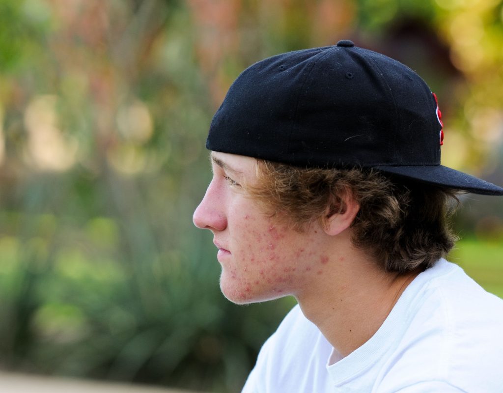 Profile of teen boy struggling with acne