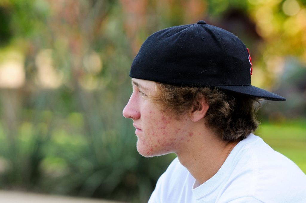 Profile of teen boy struggling with acne