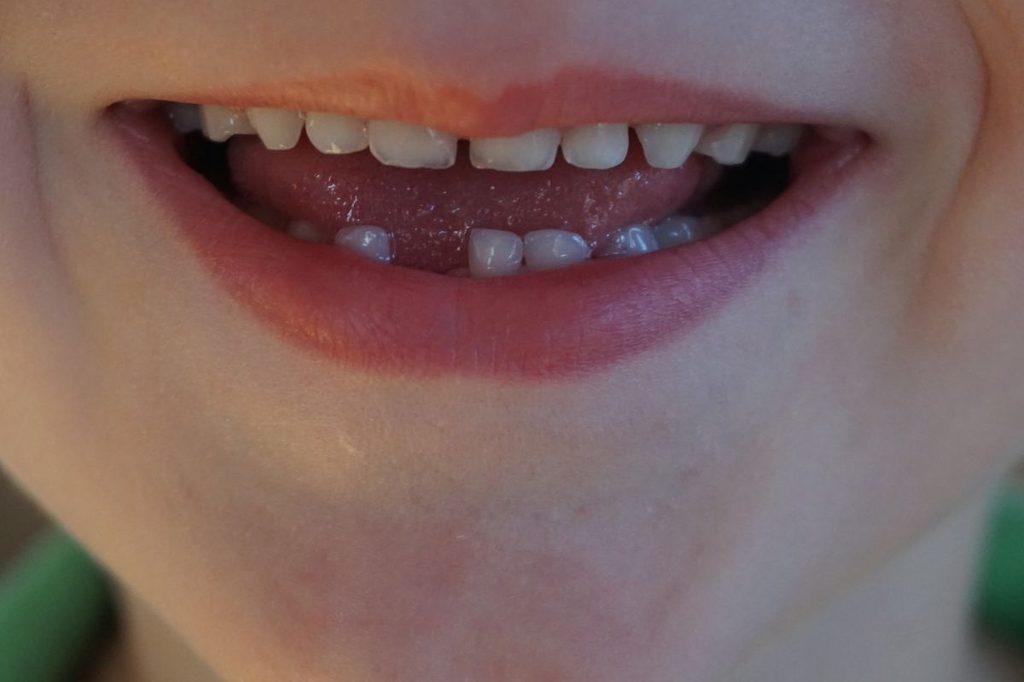 Tooth smile with missing tooth