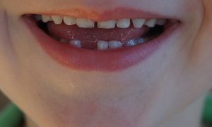 Tooth smile with missing tooth