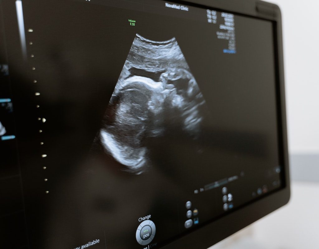 An ultrasound on a screen