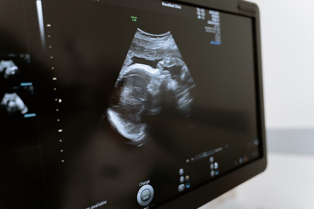 An ultrasound on a screen