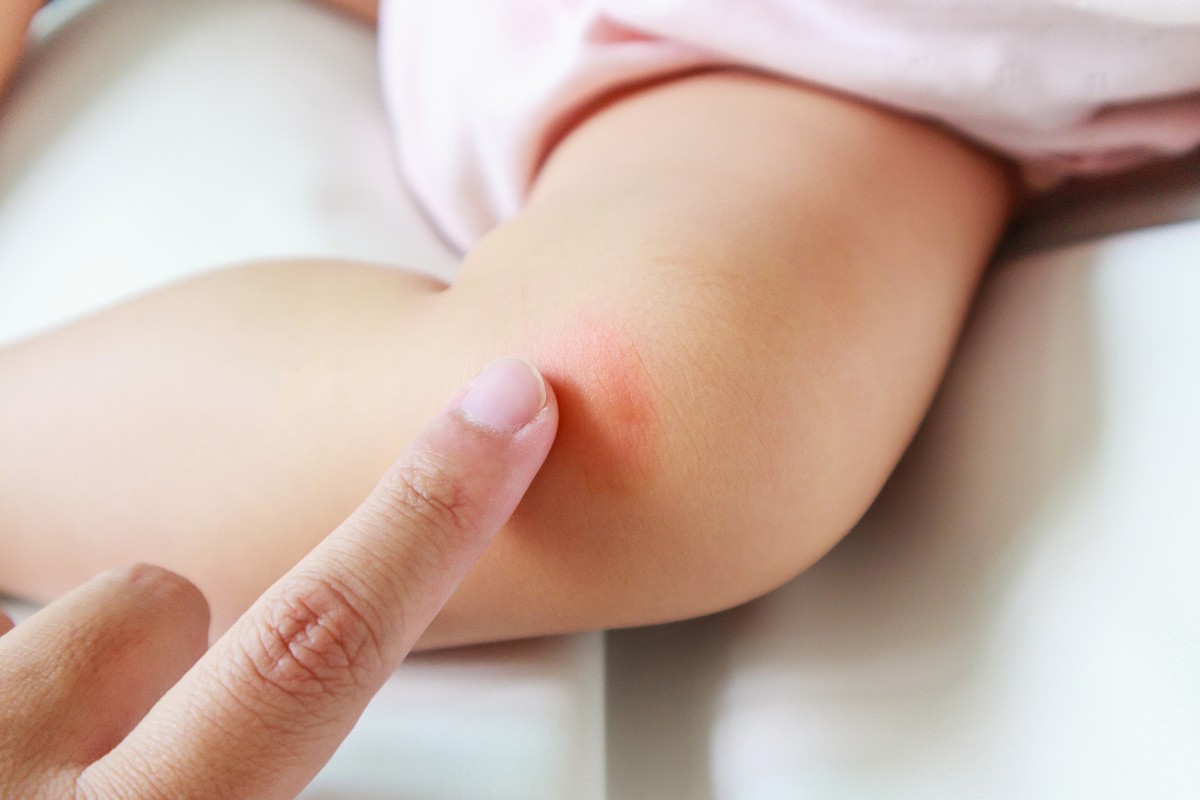 How To Treat Mosquito Bites And More On Babies Newfolks