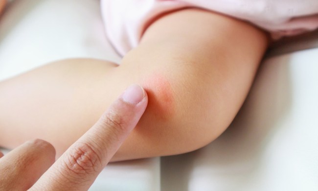 Baby with insect bite on leg
