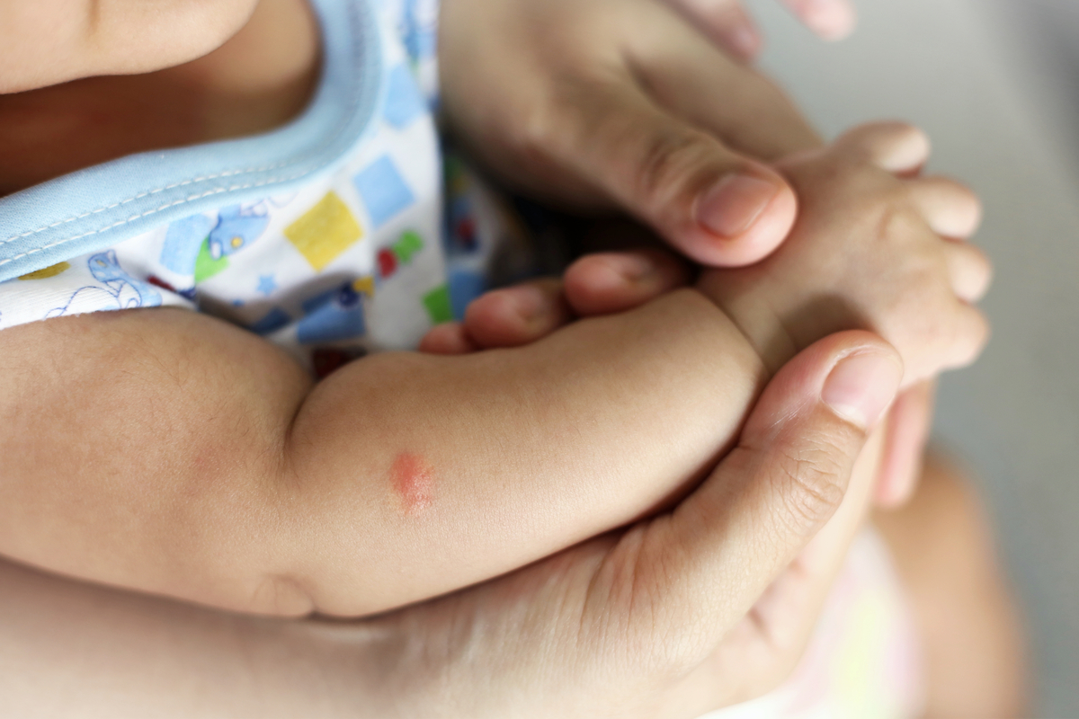 How To Treat Mosquito Bites And More On Babies Newfolks