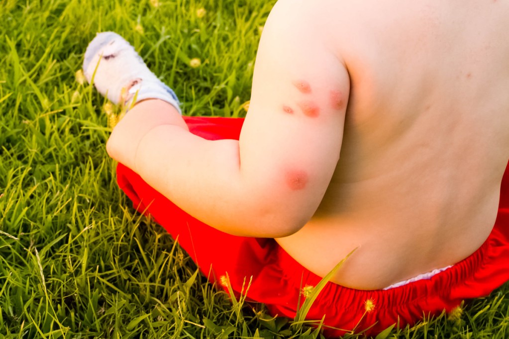 How To Treat Mosquito Bites And More On Babies Newfolks How To Treat Mosquito Bites And More On Babies Newfolks