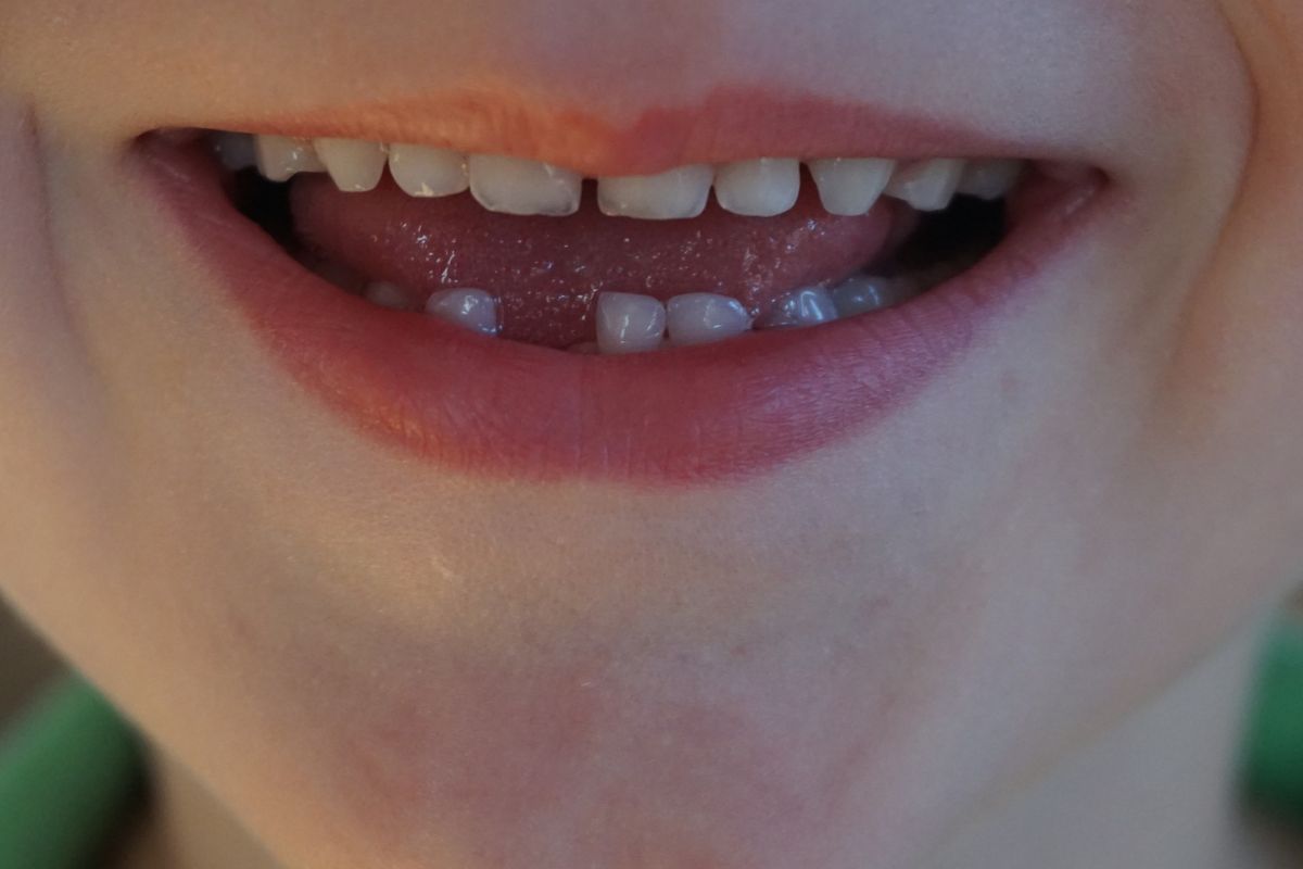 Tooth smile with missing tooth