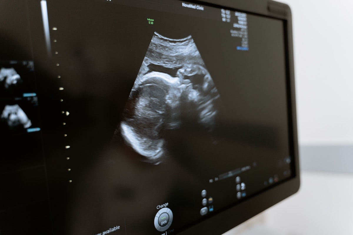 An ultrasound on a screen